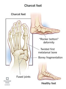 15836 charcot foot