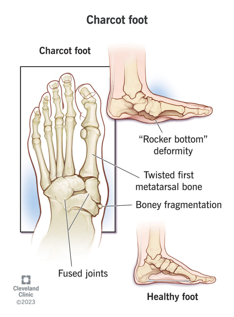 15836 charcot foot