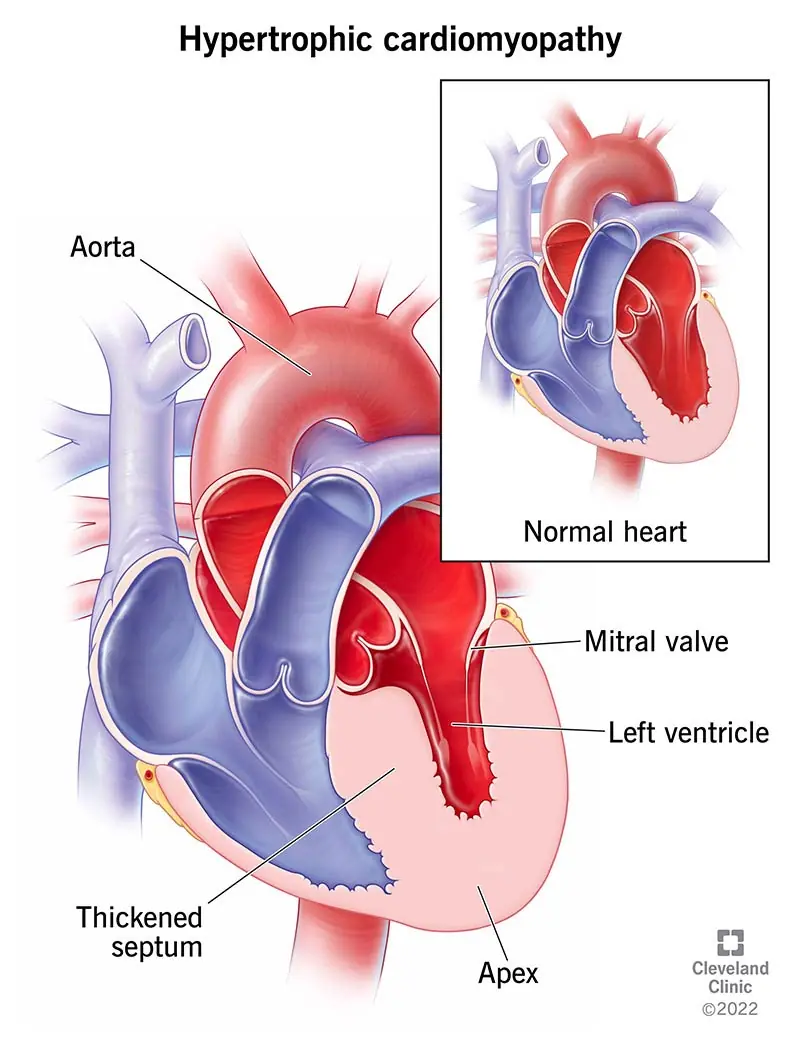 Illustrazione di cardiomiopatia ipertrofica che causa l'ispessimento del muscolo cardiaco.