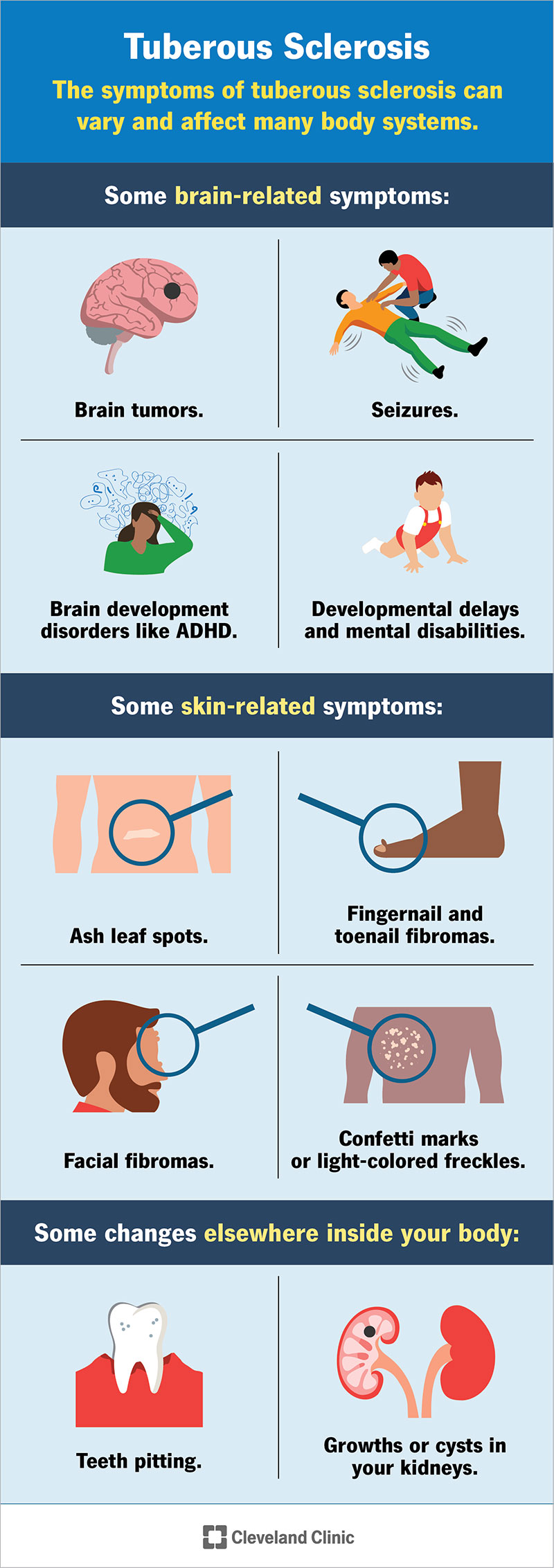 La sclerosi tuberosa provoca una crescita incontrollata delle cellule in tutto il corpo, in particolare nel cervello e sulla pelle.