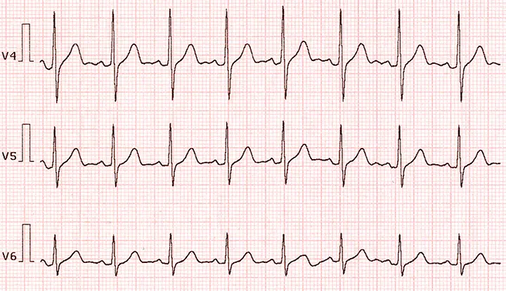 17616 normal ekg