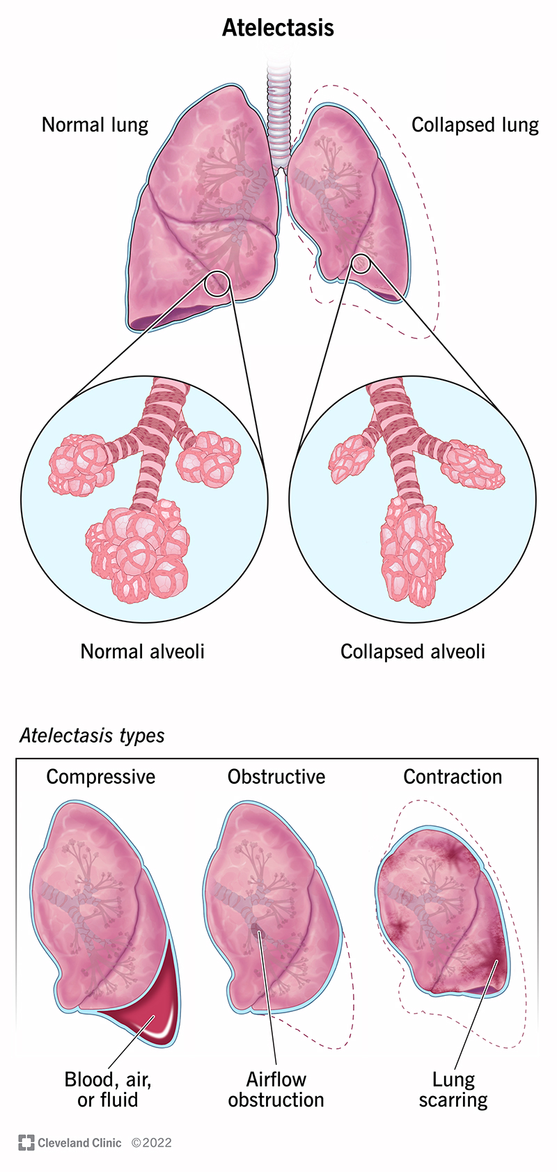 Illustrazione di un polmone completamente gonfio e di un polmone affetto da atelettasia. L'atelettasia fa apparire gli alveoli sgonfi.