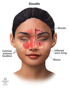 17701 sinusitis