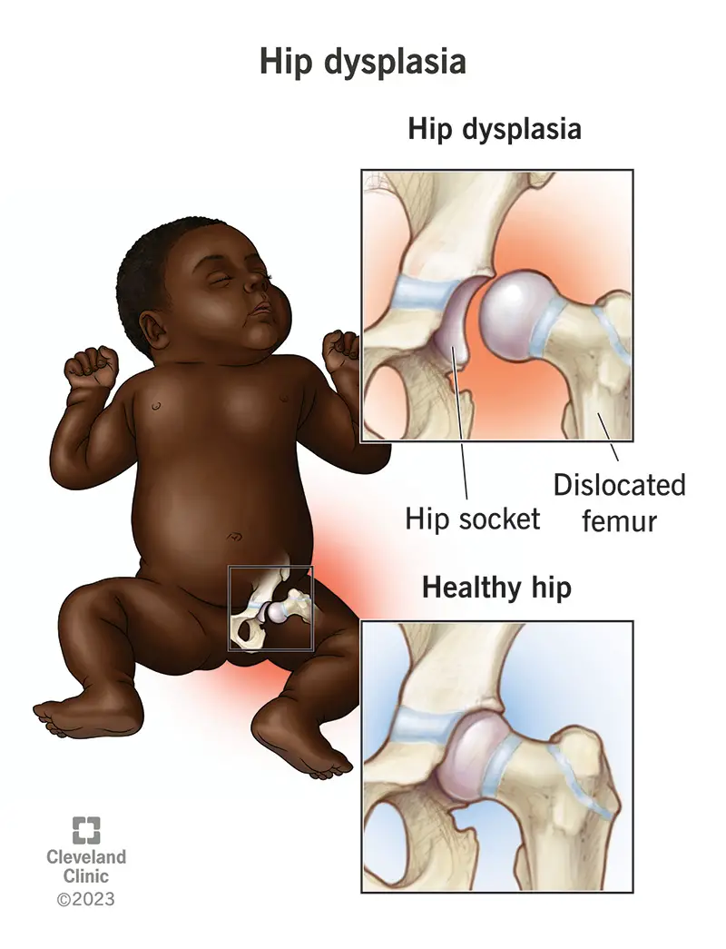 Bambino con lussazione dell'anca.