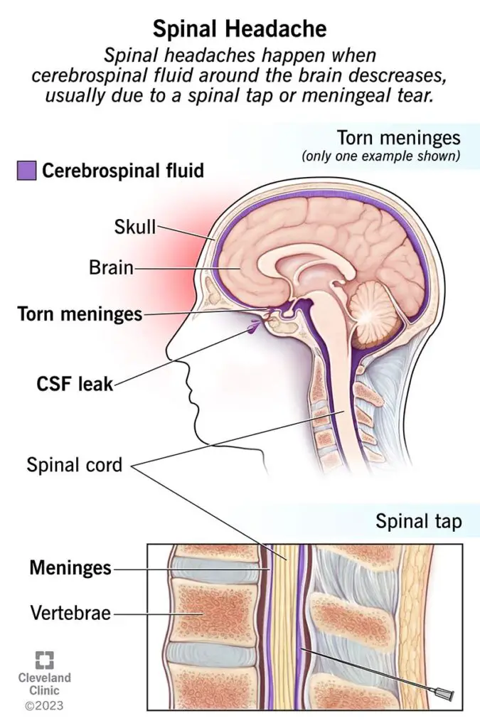 17927 spinal headaches 1