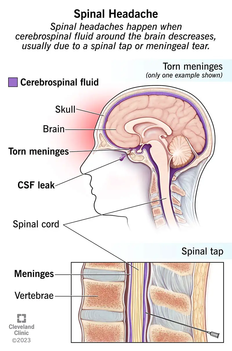 Il mal di testa spinale si verifica quando il liquido cerebrospinale attorno al cervello diminuisce, solitamente a causa di una puntura lombare o di una lacerazione meningea.