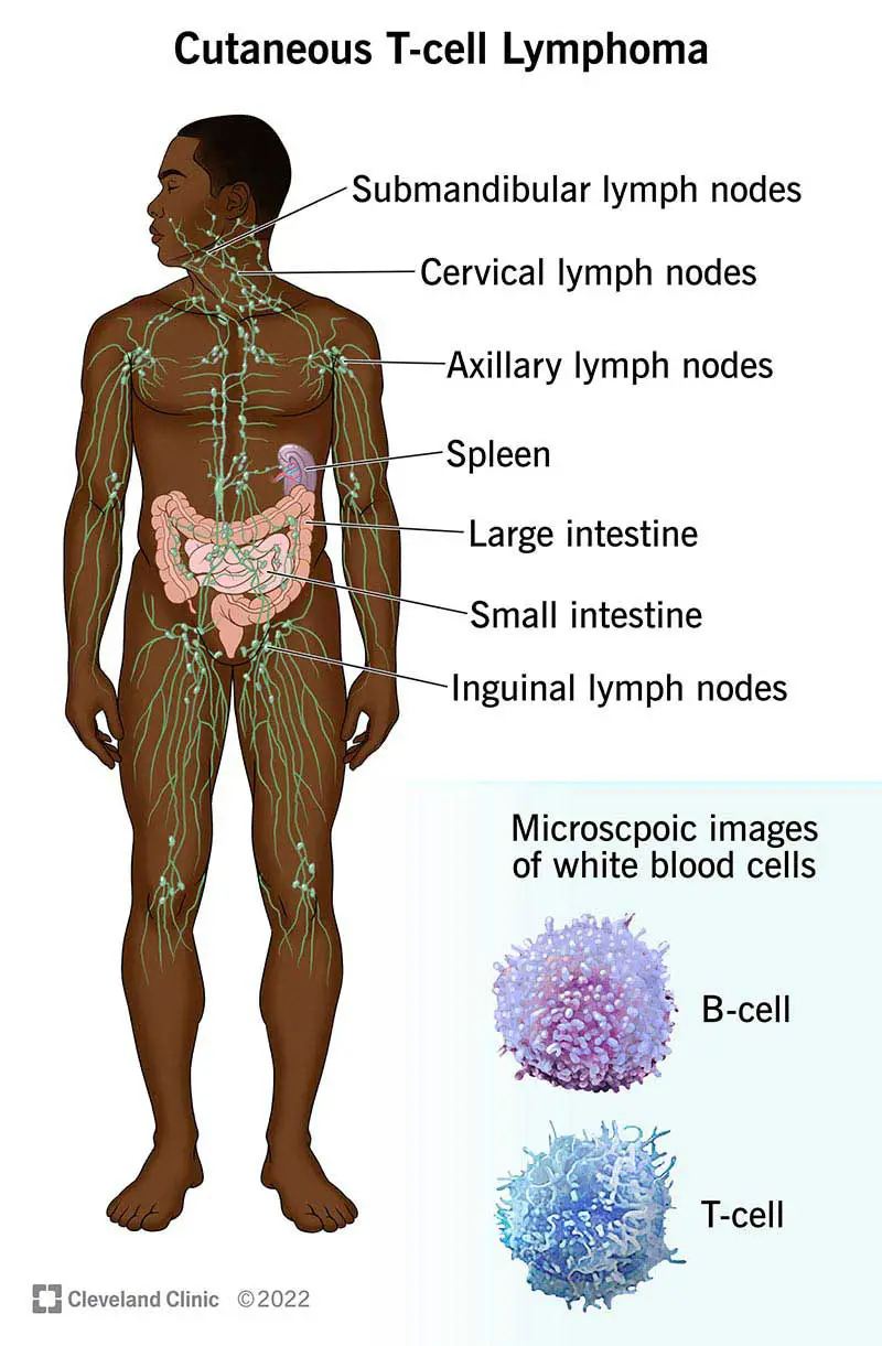 Il linfoma cutaneo a cellule T può colpire i linfonodi, la milza, l'intestino crasso, l'intestino tenue e i linfonodi inguinali.