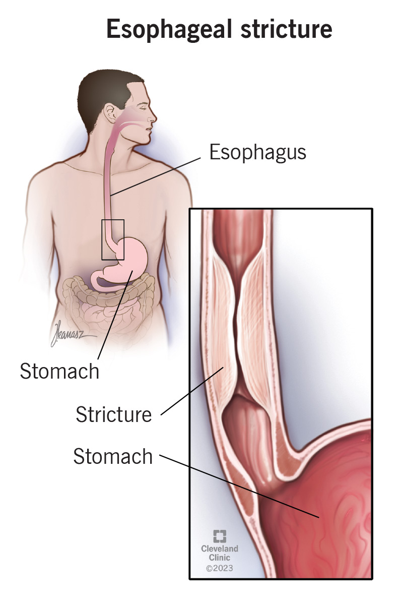 La stenosi esofagea si verifica quando l'esofago (il canale alimentare) si restringe.