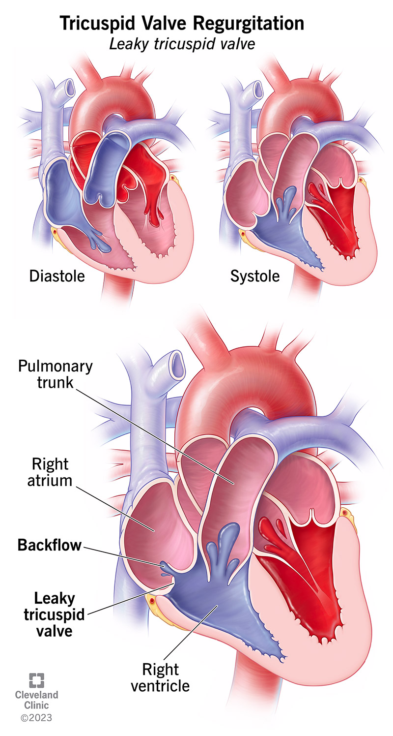 In caso di rigurgito tricuspidale, il sangue refluisce dal ventricolo destro all'atrio destro quando il cuore si contrae.