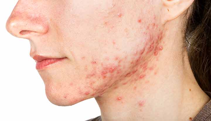 21737 cystic acne 694069284