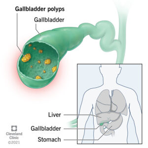 21821 gallbladder polyps.ashx