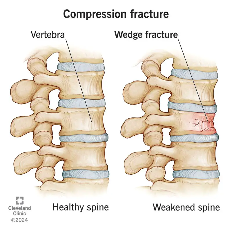 21950 compression fractures