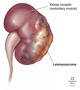 22059 leiomyosarcoma illustration