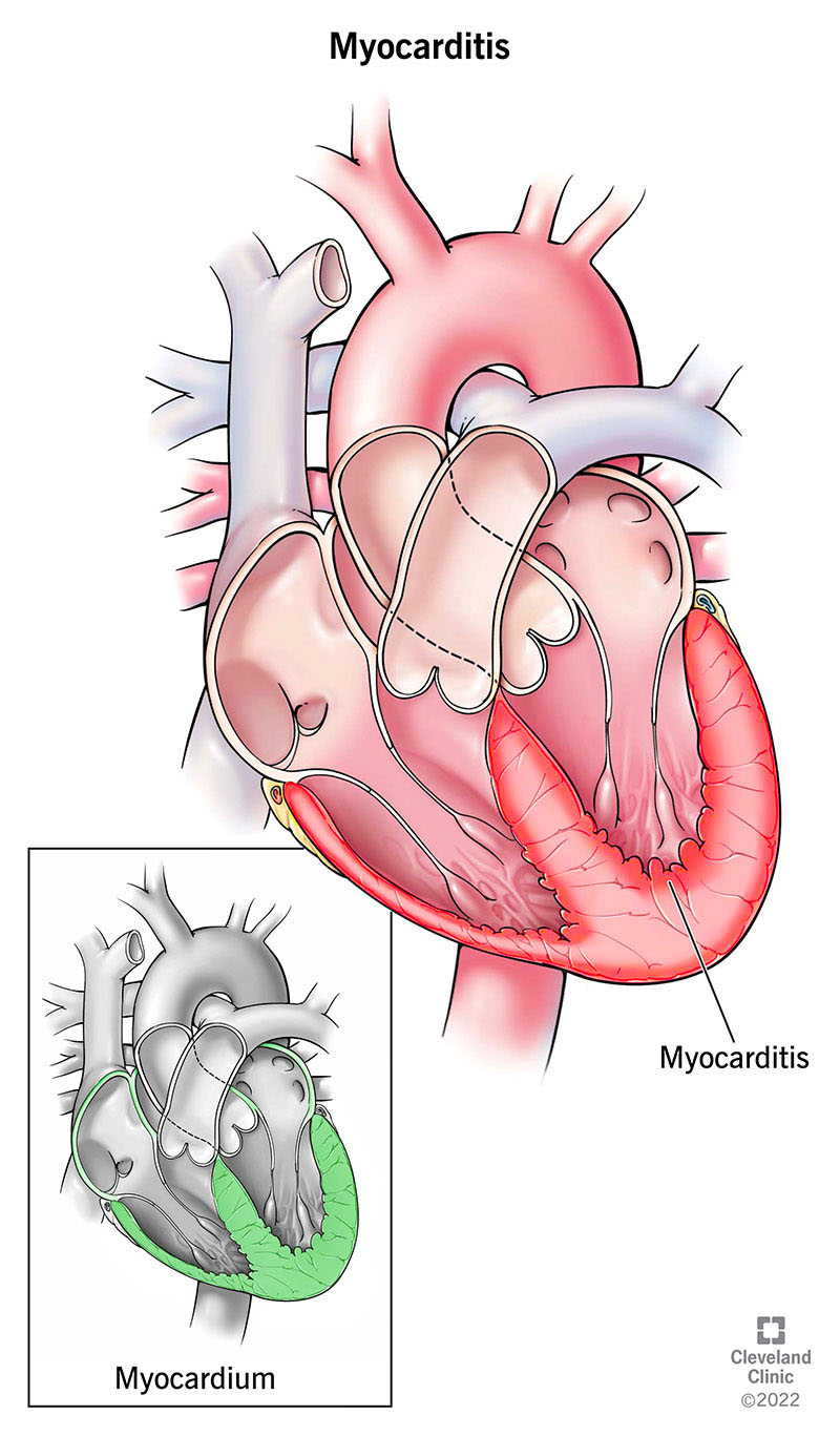 Miocardite, ovvero un'infiammazione che colpisce il muscolo cardiaco (miocardio).