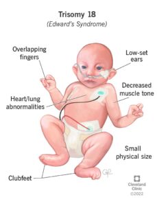 22172 edwards syndrome