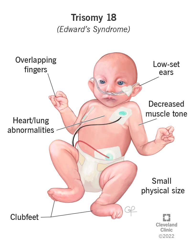 Un bambino a cui viene diagnosticata la sindrome di Edwards (trisomia 18) presenta caratteristiche fisiche uniche causate da questa condizione.