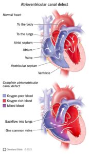 22173 atrioventricular canal defect illustration