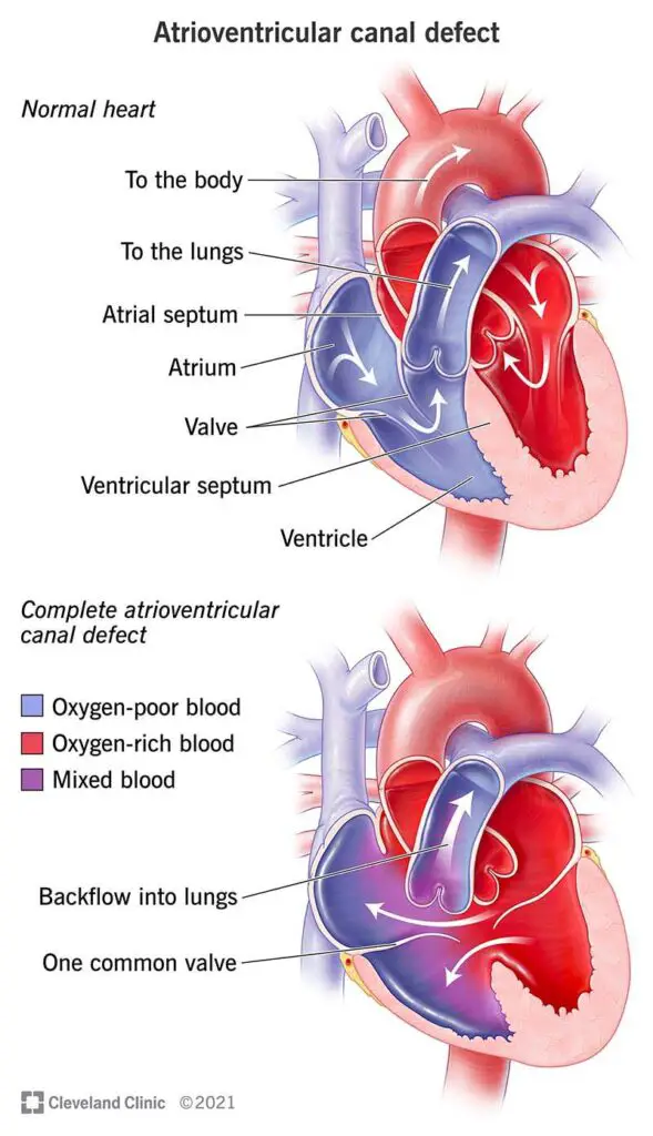 22173 atrioventricular canal defect illustration