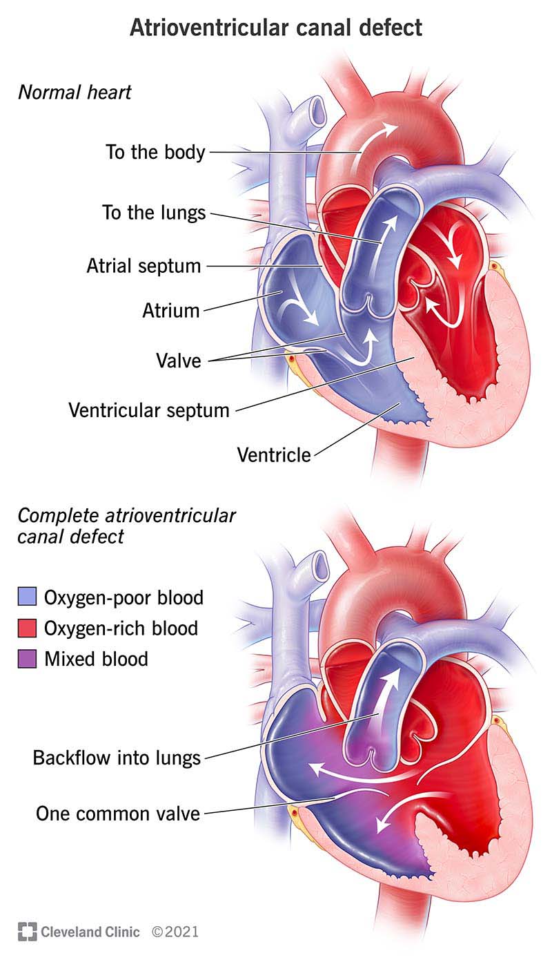 Diagramma che illustra come un difetto completo del canale atrioventricolare influisce sul flusso sanguigno.