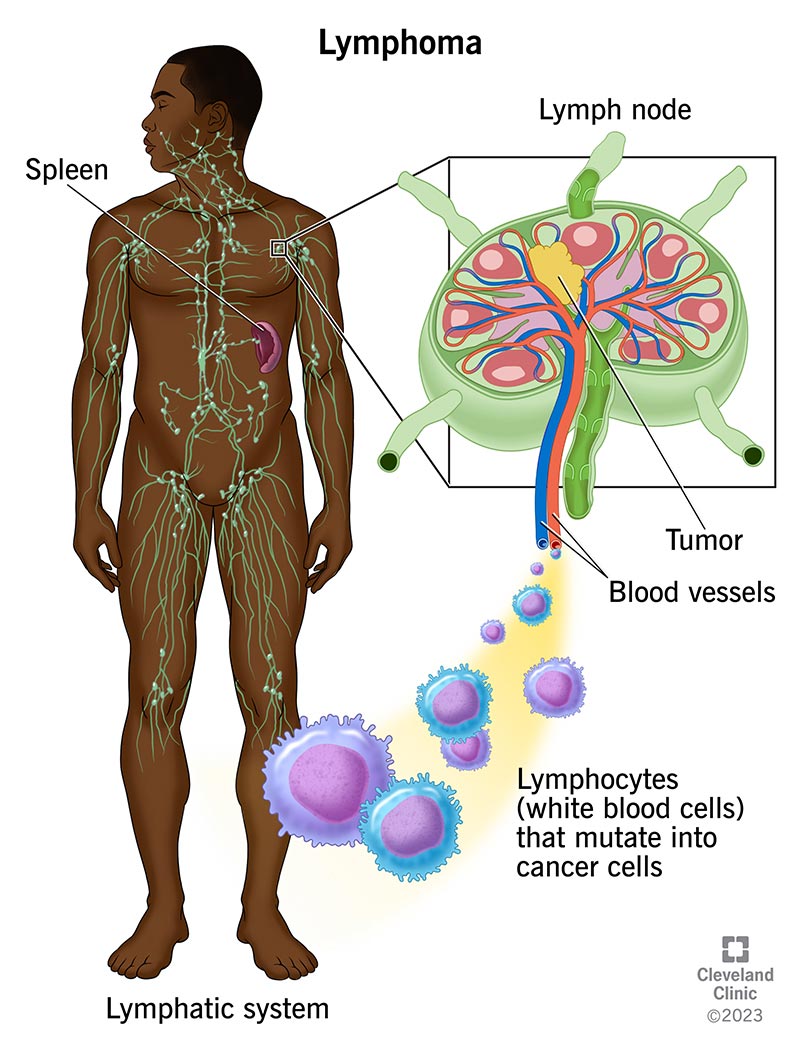 Il linfoma è un cancro che ha origine nei globuli bianchi (linfociti). Hai linfonodi in tutto il corpo. Un linfonodo gonfio può essere un segno di linfoma nel tuo linfonodo.