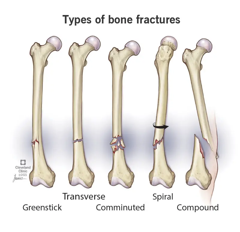 22241 spiral fractures