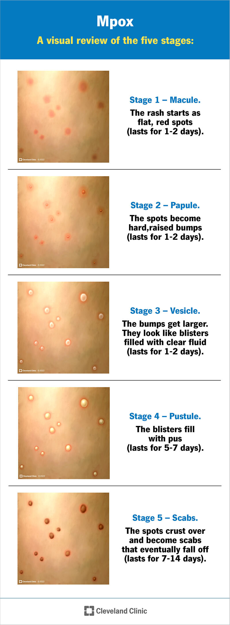 L'eruzione cutanea da Mpox inizia con macchie piatte e rosse che poi si sollevano, si riempiono di liquido e pus, poi formano una crosta e cadono.