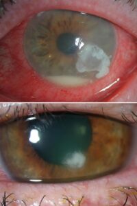 22524 corneal ulcer