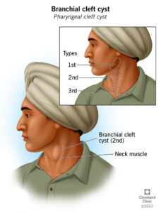 22547 branchial cleft cyst