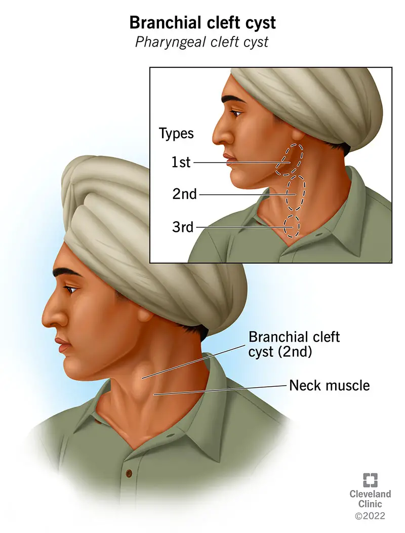 In basso: 2a cisti della fessura branchiale sotto la pelle dei muscoli del collo. Inserto: tre cisti della fessura branchiale nella mascella, nel collo e vicino alla clavicola.