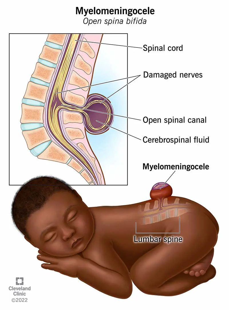 Il mielomeningocele provoca una sacca che sporge dalla schiena del bambino. Contiene parte del midollo spinale, dei nervi e del liquido cerebrospinale.