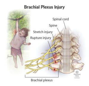 22822 brachial plexus injury