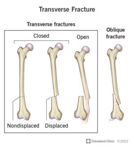 22956 transverse fracture