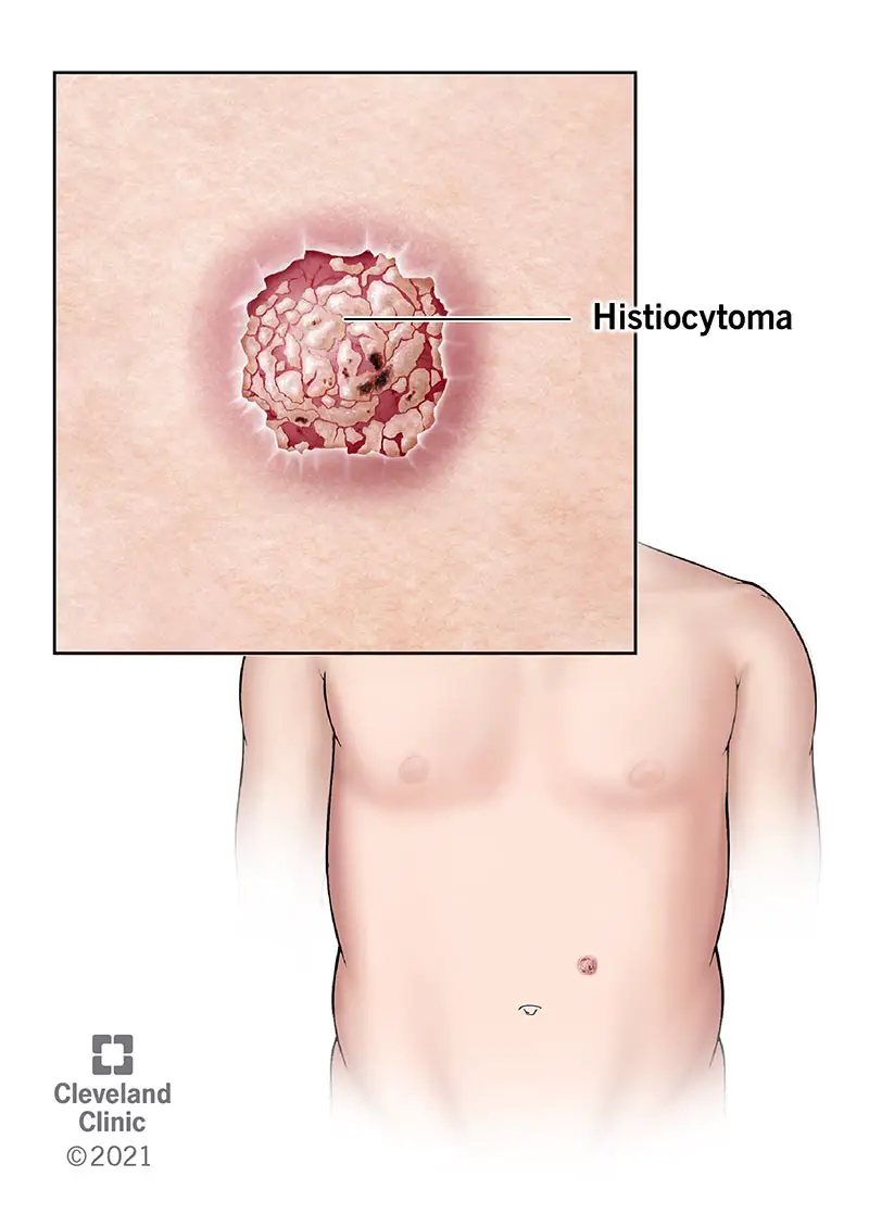 Corpo umano che mostra dove può manifestarsi l'istiocitoma.