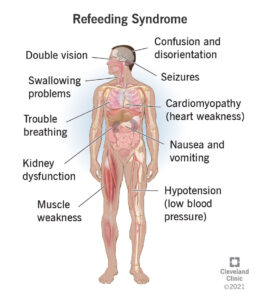 23228 refeeding syndrome