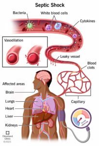 23255 septic shock