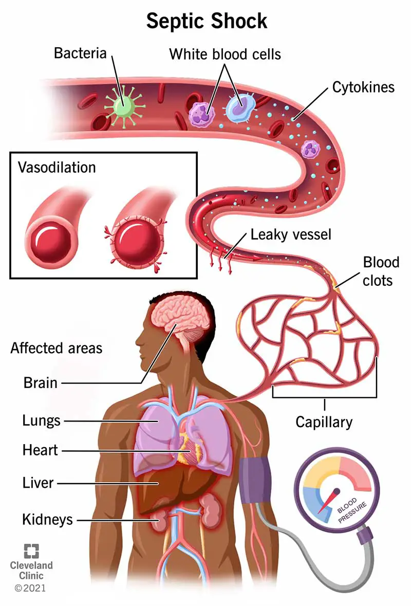 Lo shock settico si verifica quando un'infezione batterica provoca bassa pressione sanguigna, dilatazione dei vasi sanguigni e insufficienza d'organo.