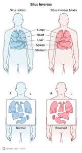 23486 situs inversus