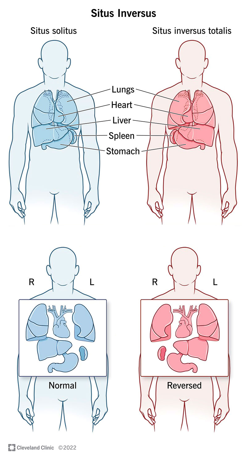 Situs inversus significa che gli organi del torace e dell'addome si trovano nella posizione inversa rispetto alla normale anatomia umana.