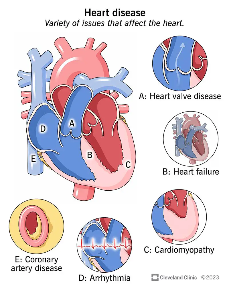 24129 heart disease illustration