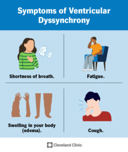 24279 ventricular dyssynchrony cv