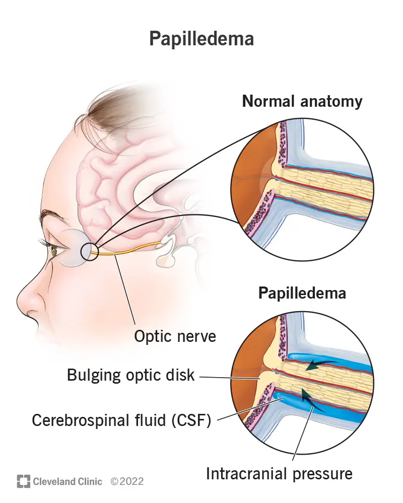 24445 papilledema