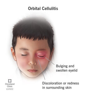 24499 orbital cellulitis