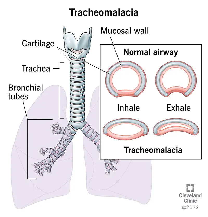 24504 tracheomalacia