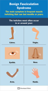 24812 benign fasciculation syndrome