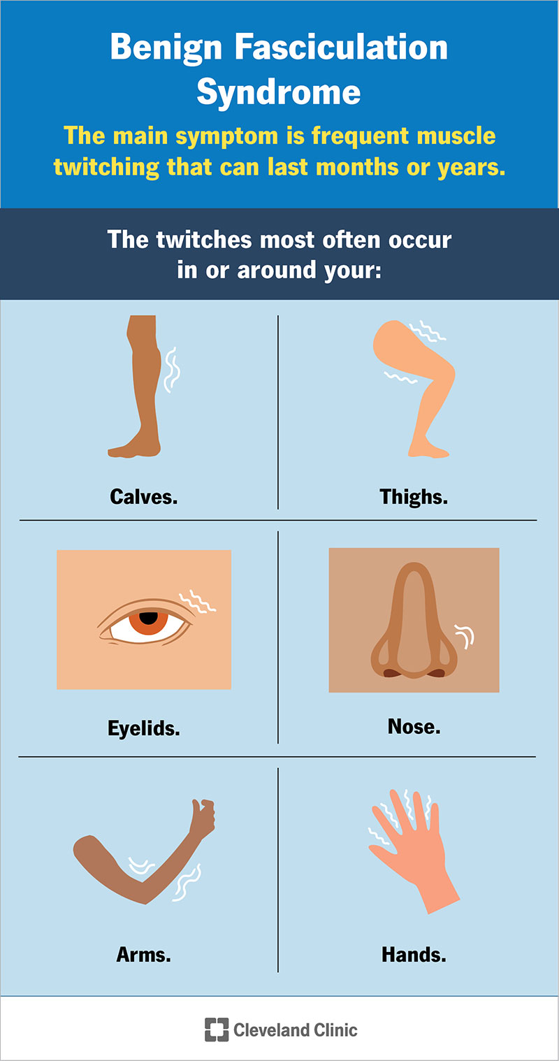 Sindrome Da Fascicolazione Benigna: Sintomi E Trattamento - SFOMC