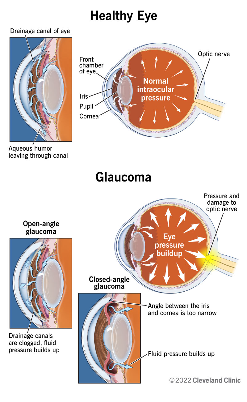 Il glaucoma è caratterizzato dall'accumulo di fluido e pressione nell'occhio, che danneggiano il nervo ottico.