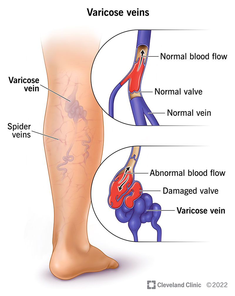 Vene varicose: cause, sintomi e trattamento 10 4722 varicose veins illustration