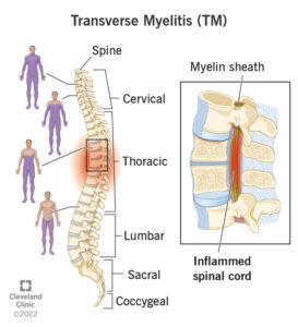 8980 transverse myelitis