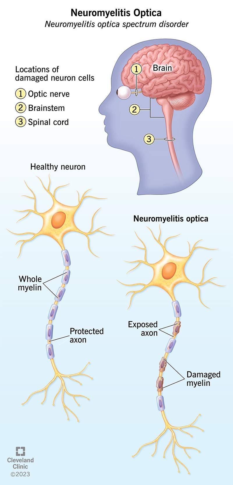 La neuromielite ottica si verifica quando il rivestimento protettivo che circonda parte di alcune cellule nervose si degrada, causando danni ai nervi.