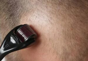 Microneedling Hair Loss 1435675177 770x533 1 jpg